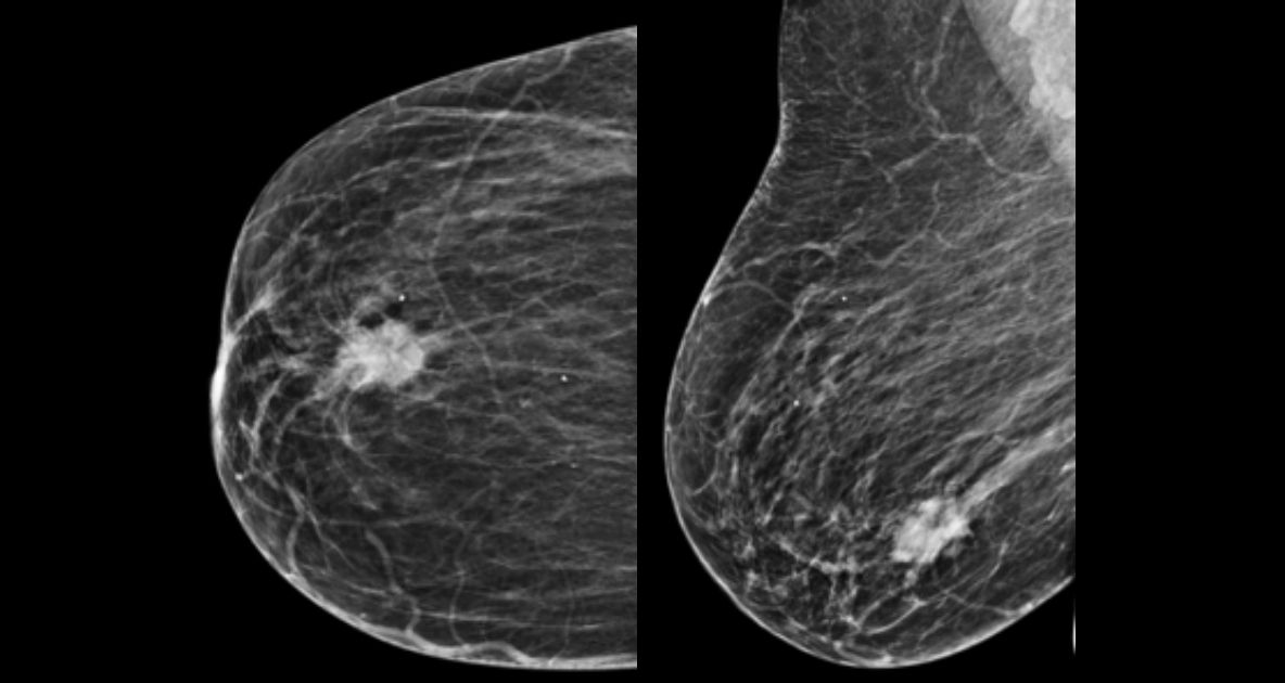 Mamografii gratuite în Teleorman, în perioada 25-28 octombrie